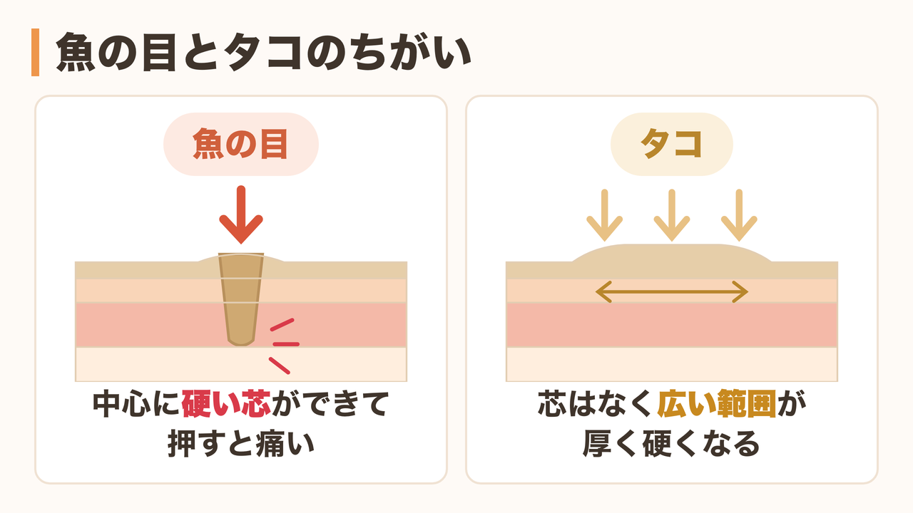 魚の目とタコの違いを皮膚の断面で比較したイラスト