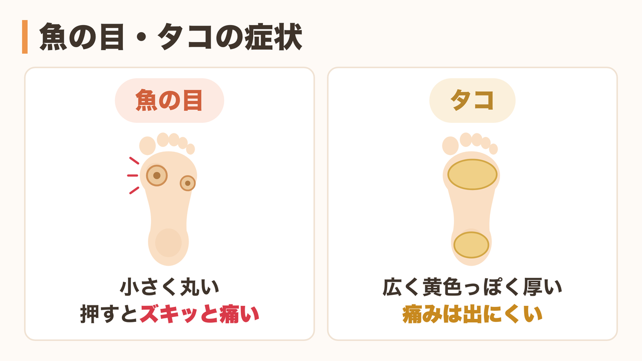 魚の目とタコの症状の違い（押すと痛い／痛みは出にくい）