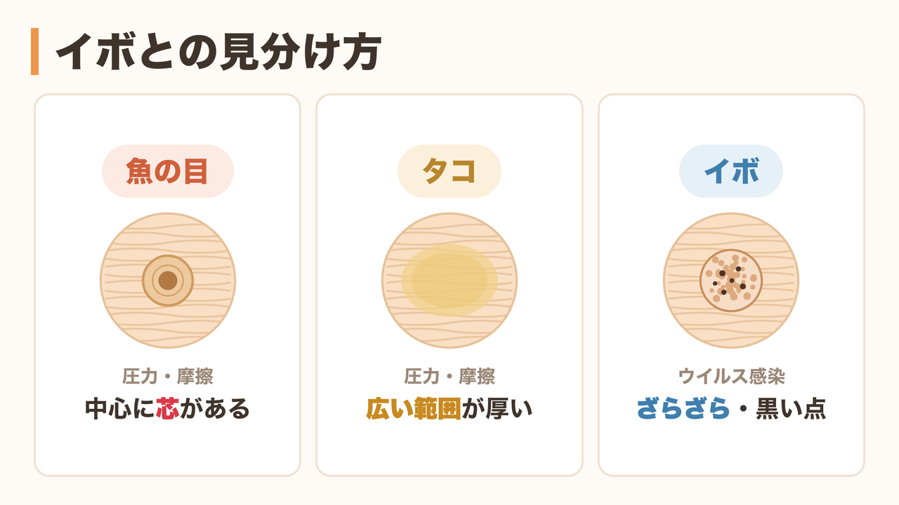 魚の目・タコとイボ（尋常性疣贅）の見分け方の比較