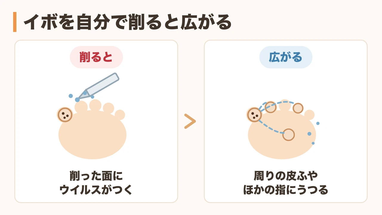 イボを削るとウイルスが周囲に広がる様子