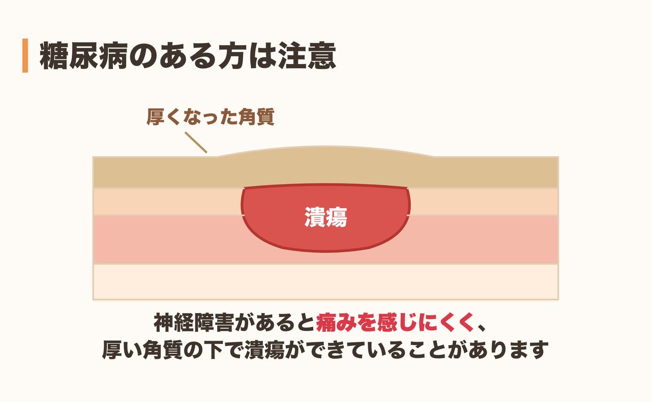 糖尿病のある方が魚の目を放置するリスク