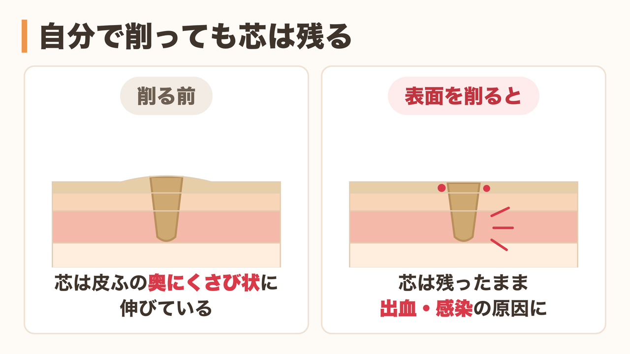 自分で削ると芯が残り出血や化膿につながることを示した図
